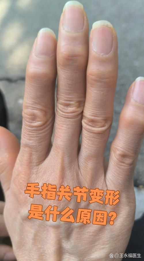 手指关节风湿能自愈吗