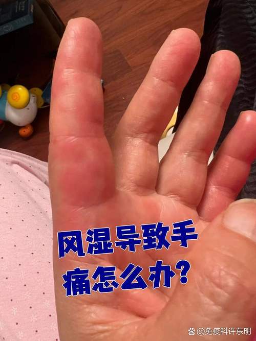手指关节风湿能自愈吗