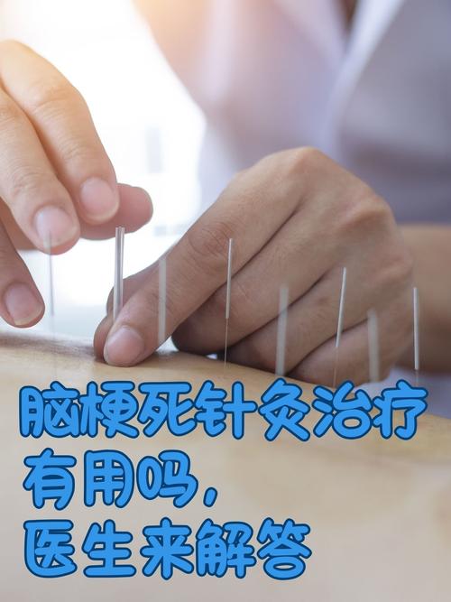 脑梗患者针灸能治好吗