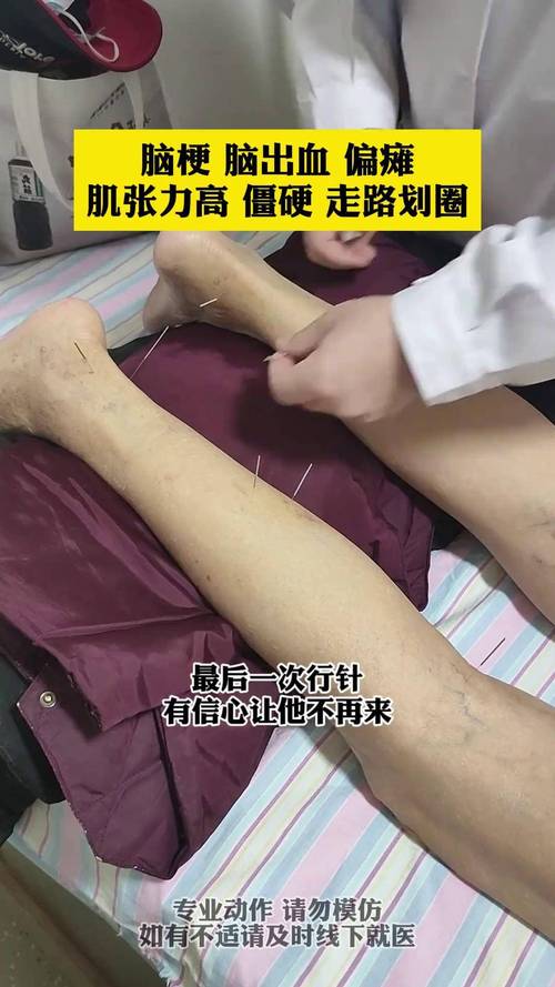脑梗患者针灸能治好吗