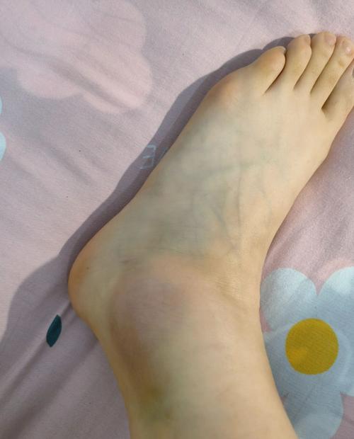 风湿会脚会麻麻的感觉