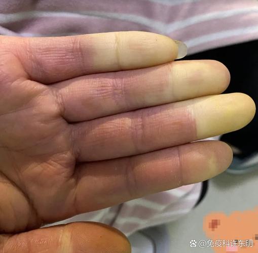 风湿免疫科干燥综合征