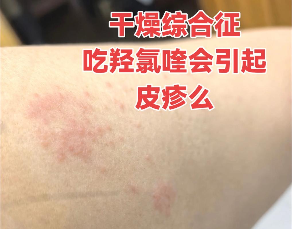 风湿免疫科干燥综合征