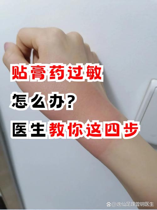 贴了风湿膏过敏怎么办