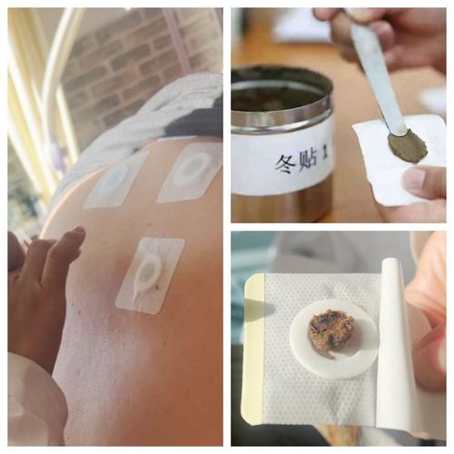 穴位贴敷 中国灸