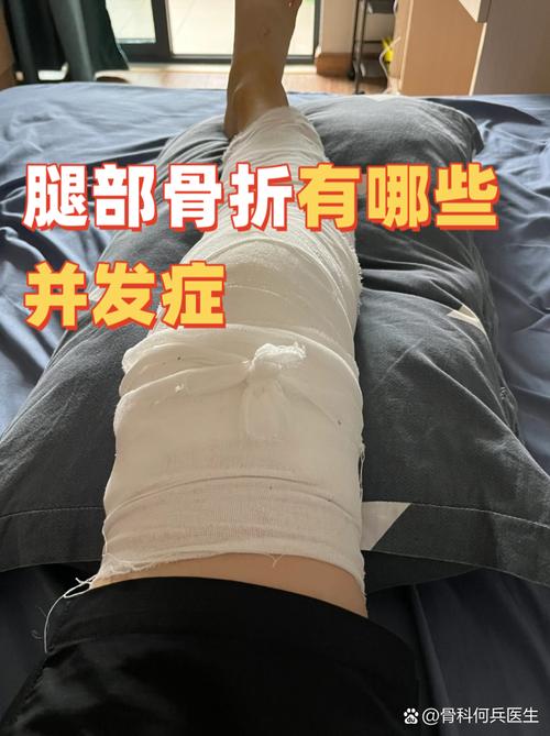 类风湿骨折后怎么治疗