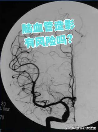 脑梗血管造影能治病吗