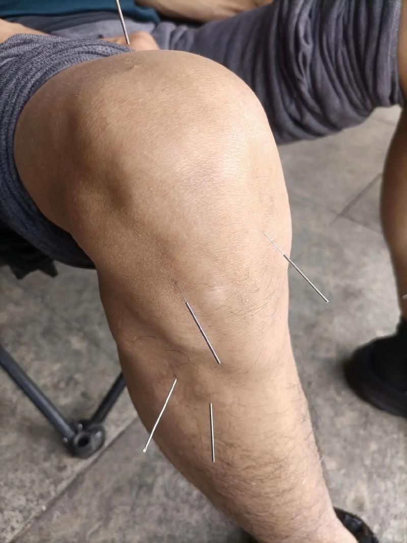 腰痛下肢疼针灸穴位