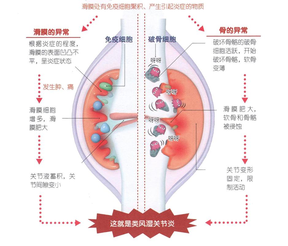 风湿免疫系统疾病种类