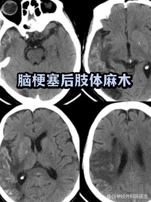 脑梗病人神经恢复正常