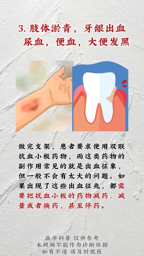 脑梗血管支架手术风险