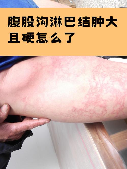 风湿病会有淋巴肿大吗