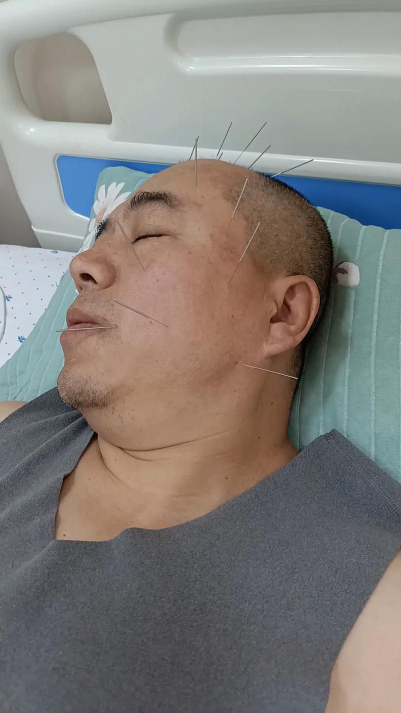 脑梗患者多久可以针灸