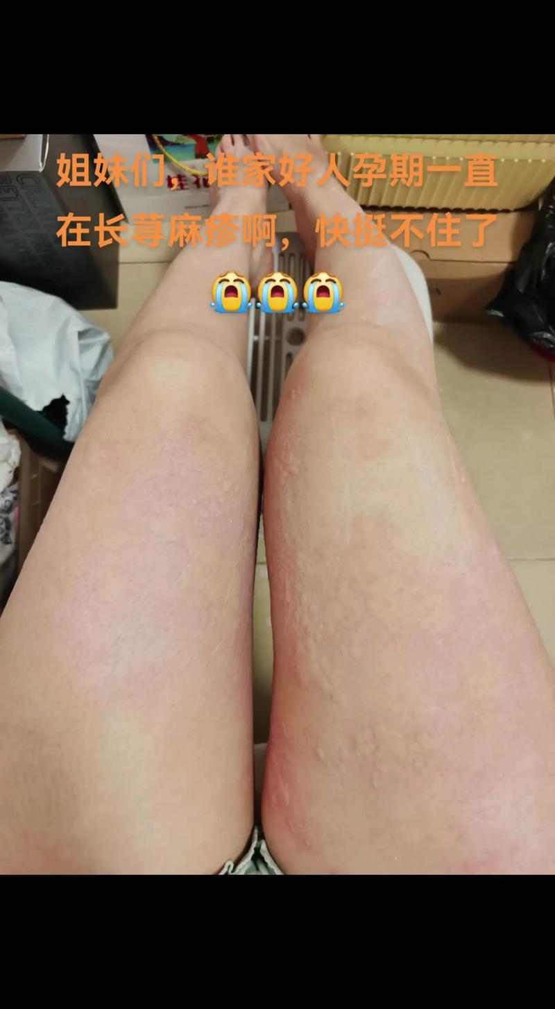 孕期长风湿疙瘩怎么办