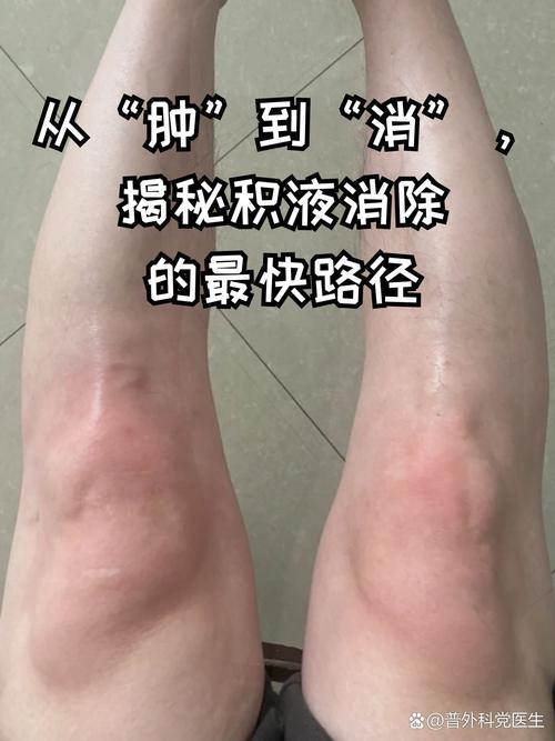 类风湿关节积液怎么办