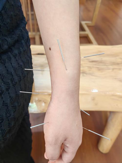 手脱皮针灸治疗穴位