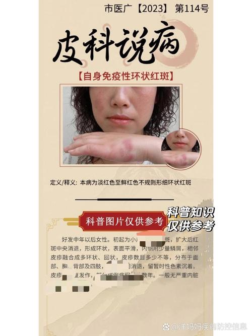 风湿性环形红斑致命吗