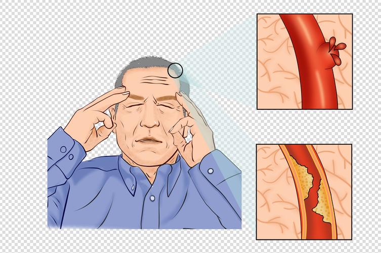 脑梗后头难受眼睛难受