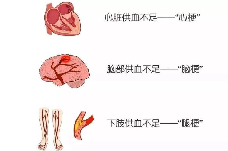 脑梗病 心梗能死人不