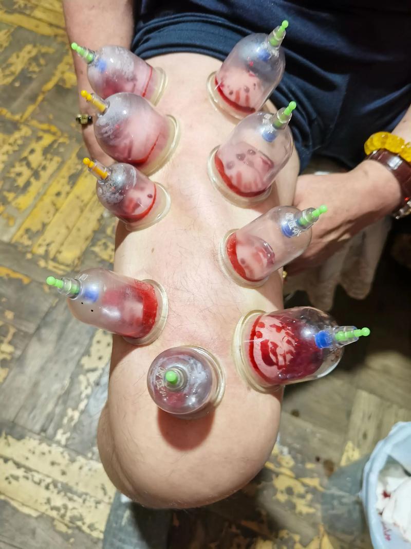 拔火罐能治小腿风湿吗