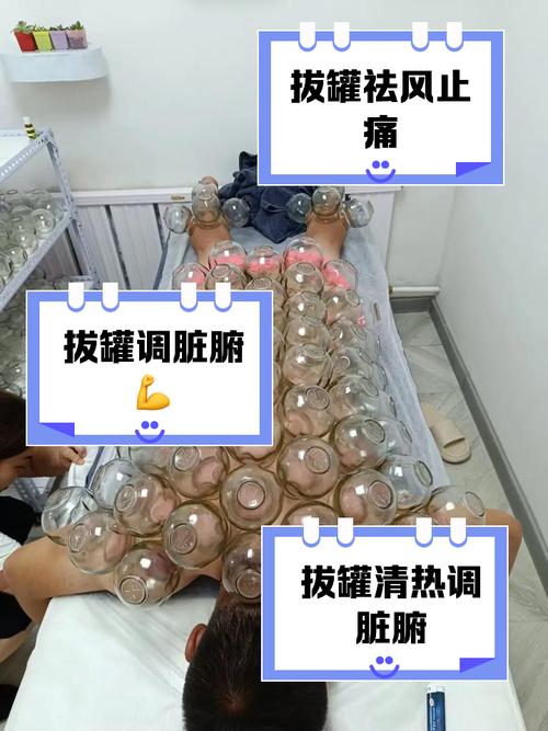 拔火罐能治小腿风湿吗