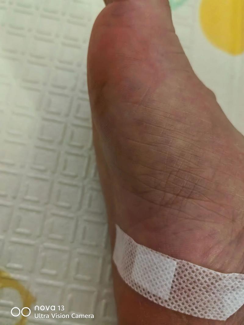 类风湿打封闭针的后果