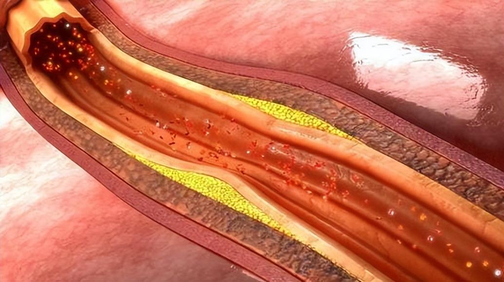 大动脉粥样硬化型脑梗