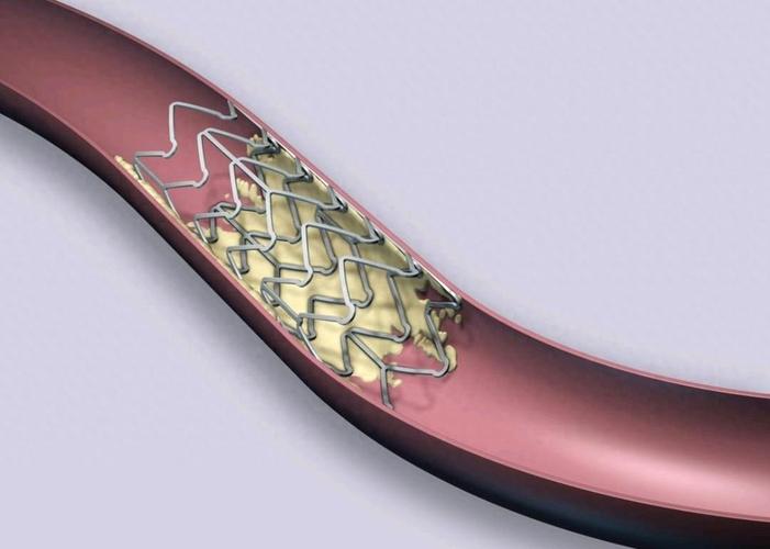 大动脉粥样硬化型脑梗