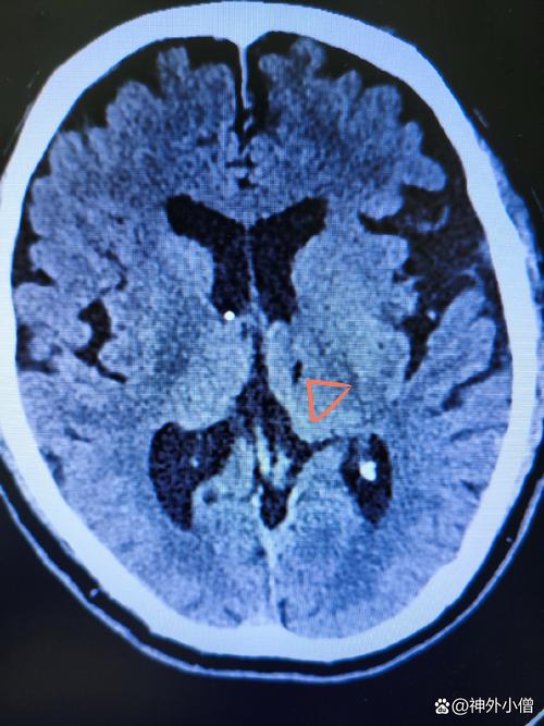 陈旧性脑梗能不能手术