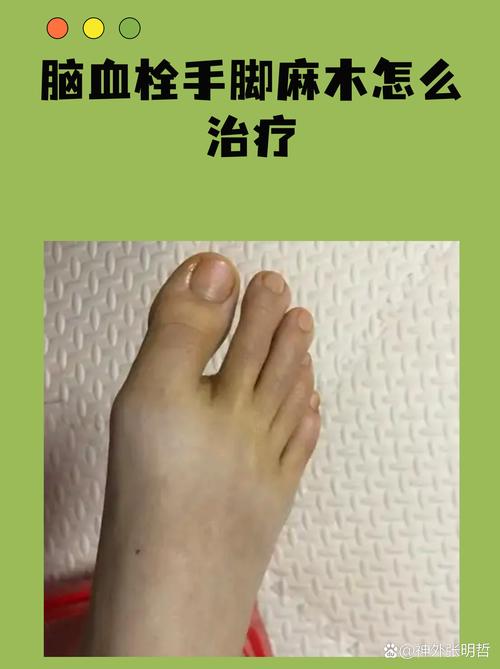 脑梗后手脚麻痛怎么办