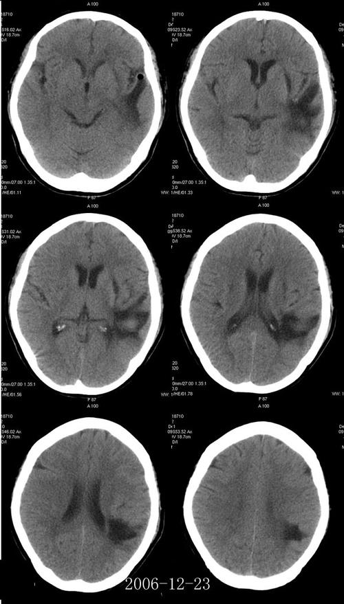 双侧多发腔隙性脑梗赛