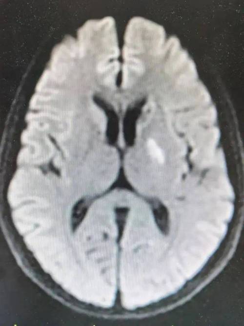卢脑右侧基底节区腔梗