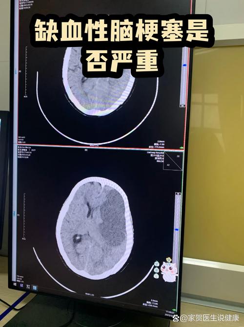 天坛医院看脑梗怎么样