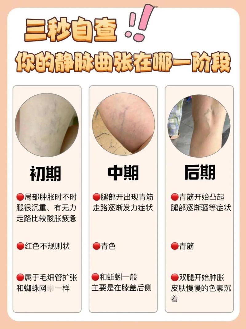 脑梗静脉曲张有关联吗