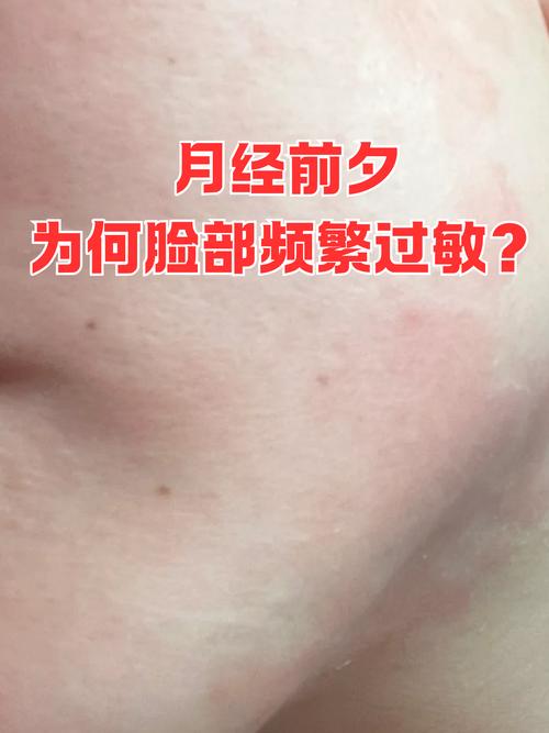 类风湿会引起脸发痒吗