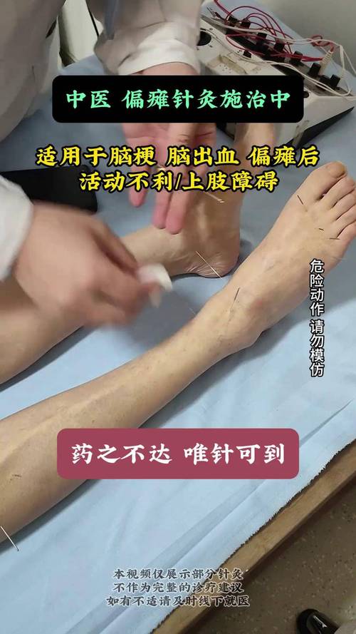 脑出血针灸治疗穴位