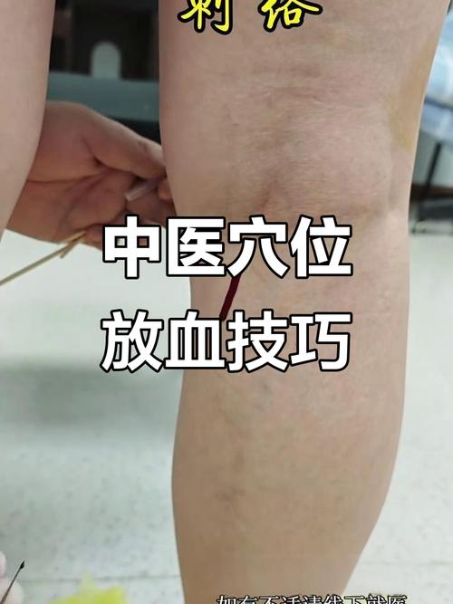 放血疗法能治类风湿吗