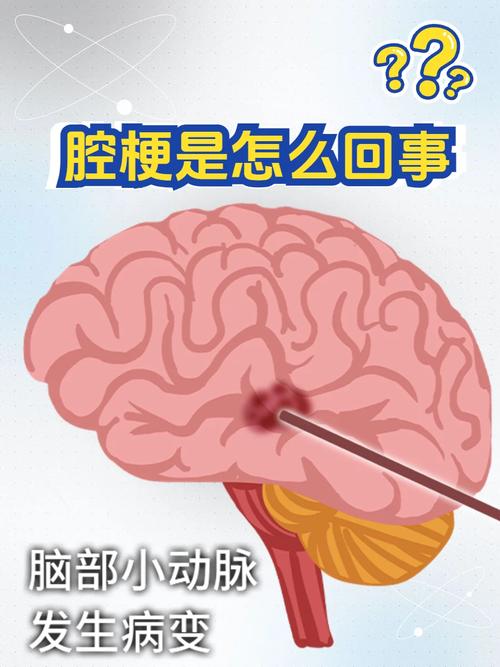 脑内多发腔梗并脑缺血