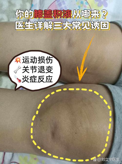 类风湿之后膝关节积水