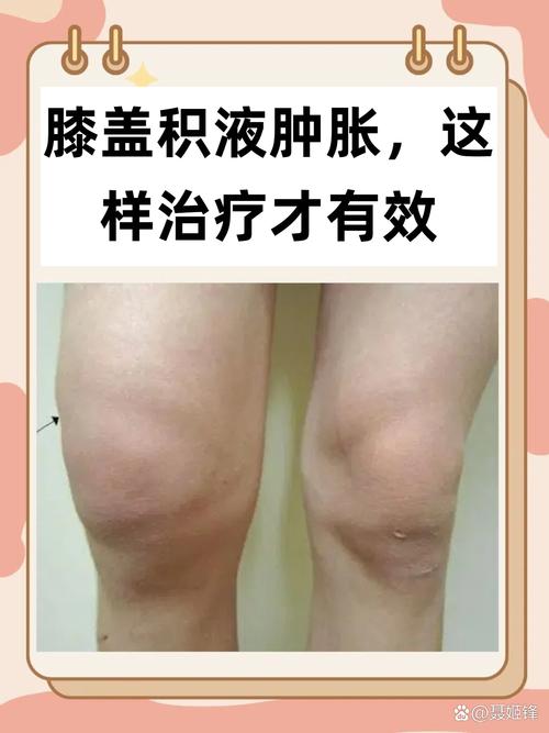 类风湿之后膝关节积水