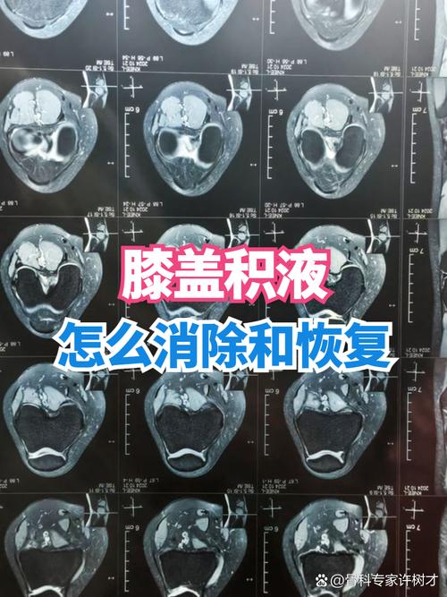 类风湿之后膝关节积水