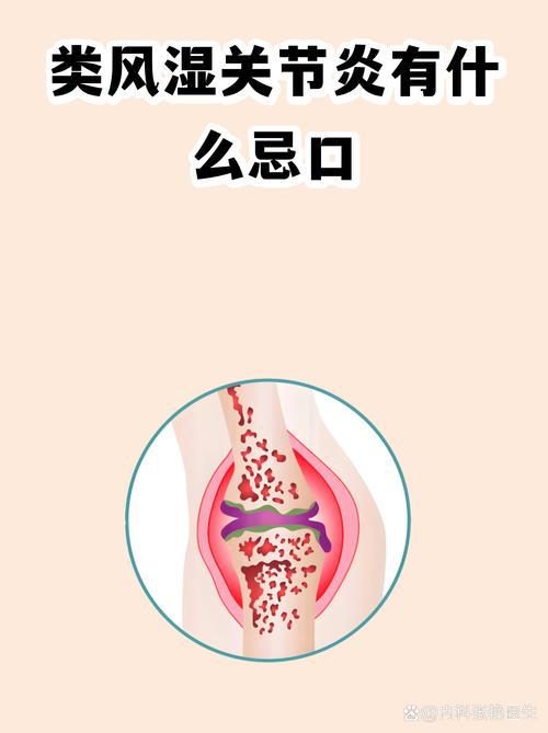 怀孕后类风湿症状减退