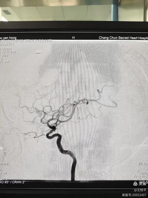 大面积脑梗且脑干梗死