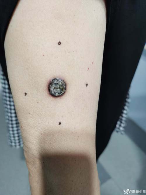 类风湿肘部淋巴结肿大