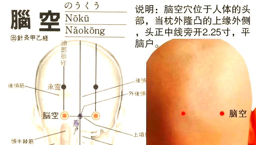 脑出血偏瘫打通穴位