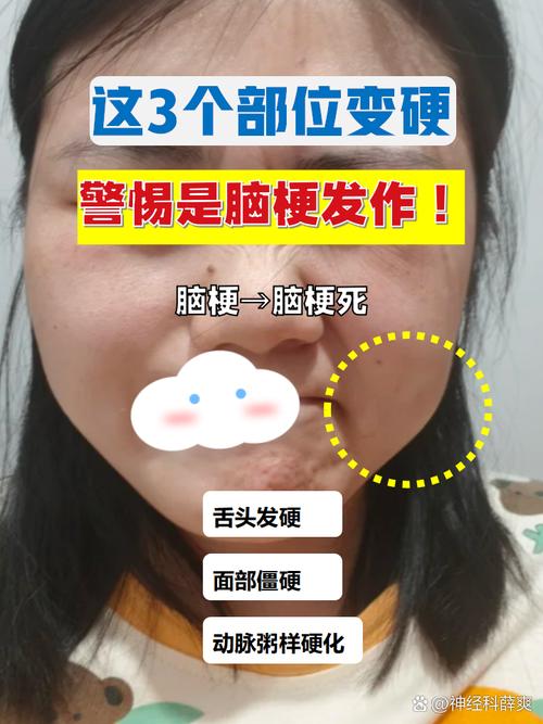 头晕脸肿是脑梗引起吗