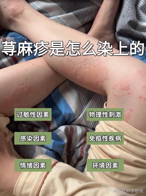 荨麻疹是不是风湿疙瘩