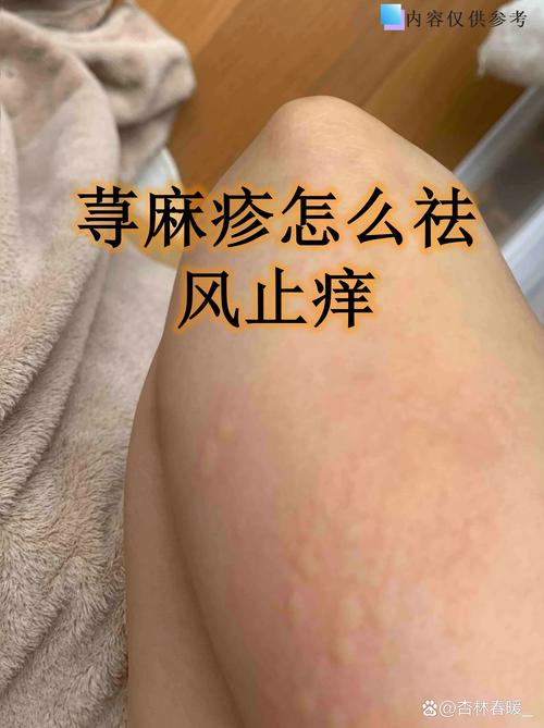 荨麻疹是不是风湿疙瘩