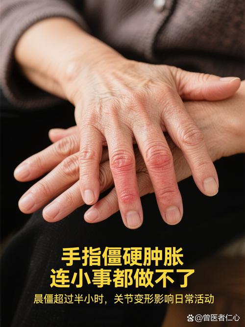 排除类风湿的手指晨僵