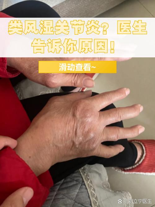 排除类风湿的手指晨僵